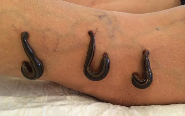 leech therapy